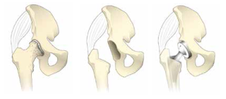 artificial-joint-center_hip_joint_img01
