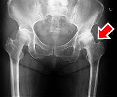 artificial-joint-center_hip_joint_img02