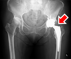 artificial-joint-center_hip_joint_img03