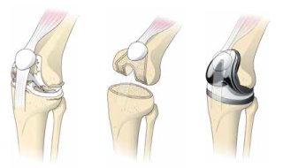 artificial-joint-center_knee_joint_img01