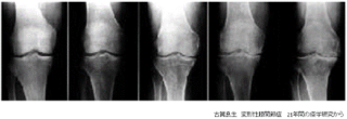 artificial-joint-center_knee_joint_img03