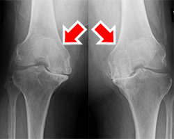 artificial-joint-center_knee_joint_img04