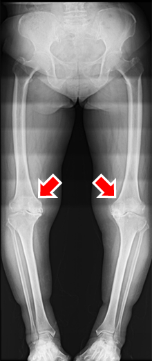 artificial-joint-center_knee_joint_img06