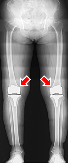 artificial-joint-center_knee_joint_img07