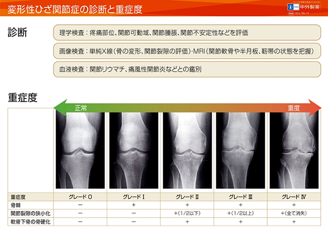 artificial-joint-center_knee_joint_img08