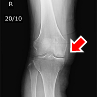 artificial-joint-center_knee_joint_img11