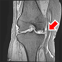 artificial-joint-center_knee_joint_img12