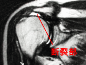 図4：腱板断裂のMRI