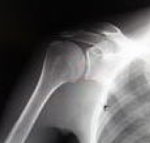 図1：正常な肩関節