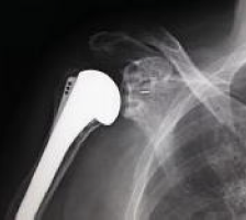 図3：人工肩関節置換術