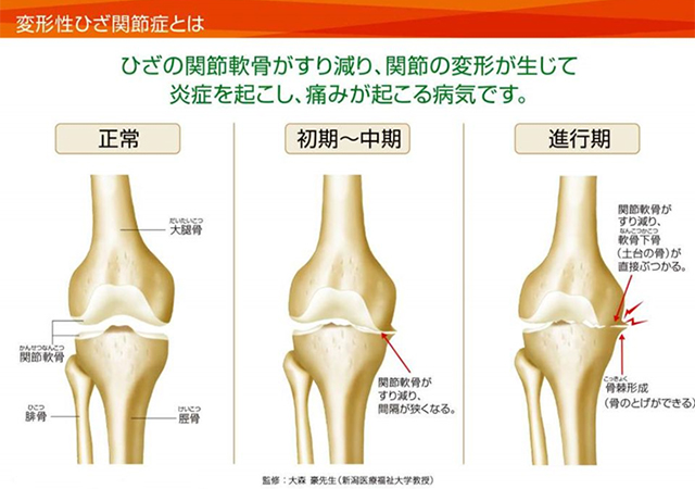 変形性膝関節症